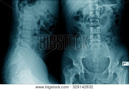 Lumbar Spondylosis X-ray Image Ap And Lateral View