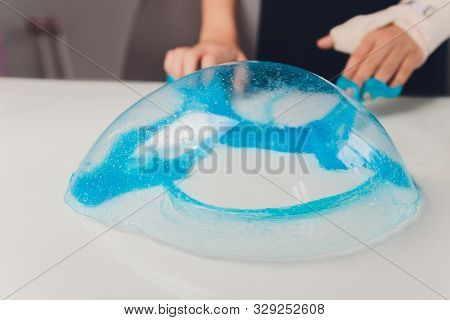 Kid Playing Hand Made Toy Called Slime Alien Drool Shell Mussel. Childrens Hand In A Cast
