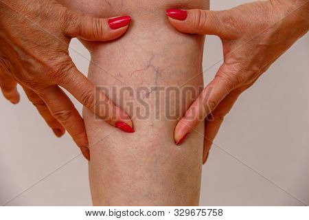 Elderly Woman In White Panties Shows Cellulite And Varicose Veins On A Light Isolated Background. Co