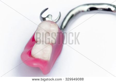 Half Of The Removable Denture On The Lower Jaw. False Teeth. Implants. Clasp Prosthesis On The Lower