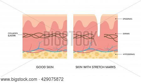 Anatomy Of Skin With And Without Stretch Marks. Colleagen, Elastin, Striae. Body Positivity, Beauty,