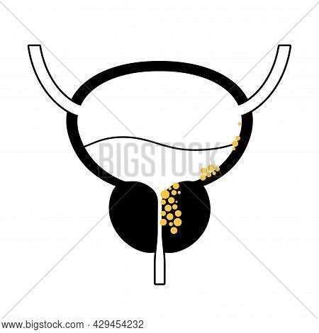 Bladder Cancer Icon. Stones In Bladder, Urethra, Lymph Nodes And Prostate In Male Body. Inflammation