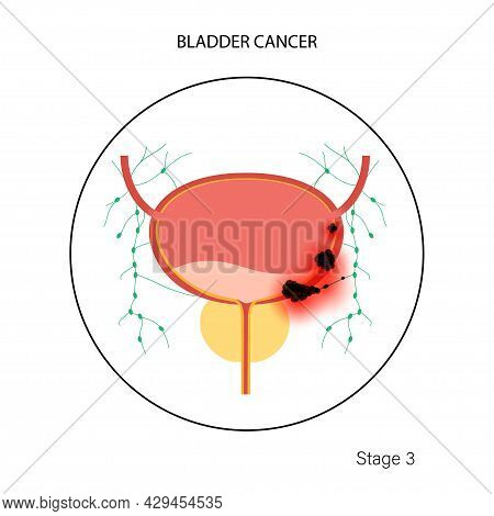 Bladder Cancer Third Stage Of Tumor Spreading. Bladder, Urethra, Lymph Nodes And Prostate In Male Bo