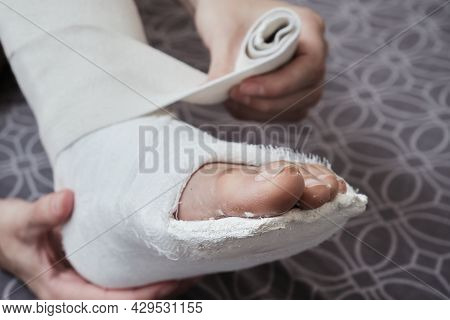 Applying An Elastic Bandage To A Broken Leg The Leg Is In A Plaster Cast. Home Rehabilitation After