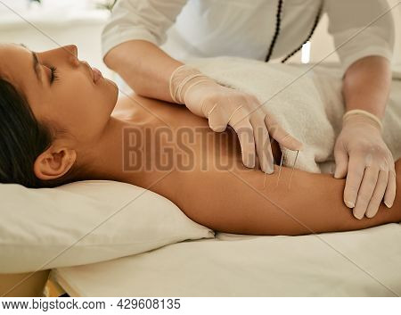 Woman Patient Receives Body Acupuncture Procedure Lying Down In Asian Wellness Salon