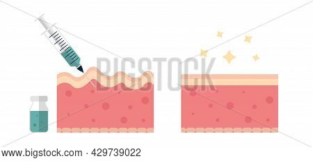 Skin With Wrinkles And Fine Line Before And After Injection Flat Illustration. Dermatology, Collagen