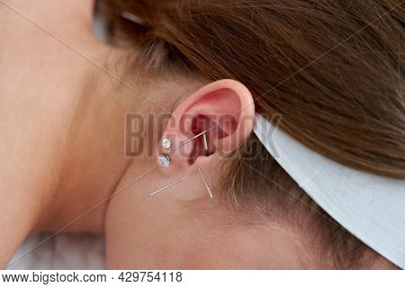 Beautiful Woman Relaxing On A Bed Having Acupuncture Treatment With Needles In And Around Her Ear. A