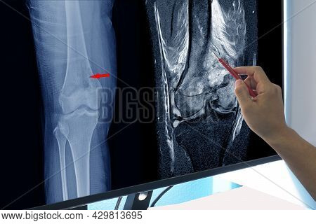 Magnetic Resonance Imaging (mri) Of Right Knee Suggestive Of Malignant Bone Tumor, Involving Epiphys