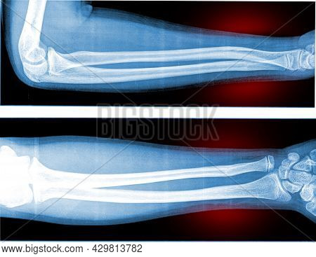 Film X-ray Forearm And Wrist Joint (ap,lat) Closed Fracture At Distal Part Of Diaphysis Of Radius Wi