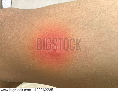 Red Blisters On Human Skin Due To The Bite Of A Poisonous Insect.