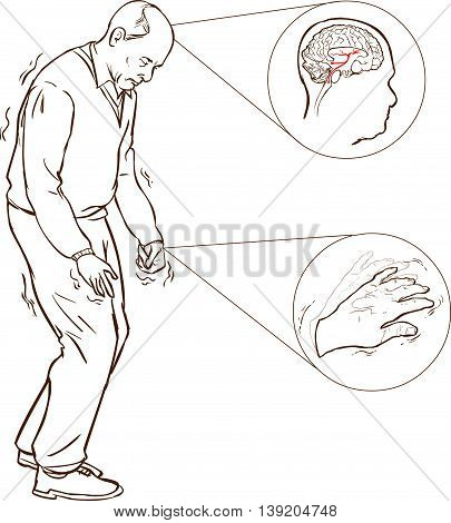 Old man with Parkinson symptoms difficult walking