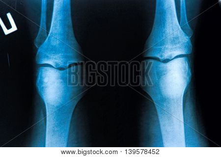 X-Ray image of the human knees: medical concepts