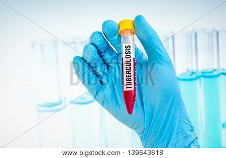 Test-tube With Blood Sample For Tuberculosis Test