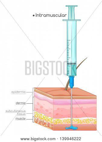 Diagram showing intramuscular injection illustration