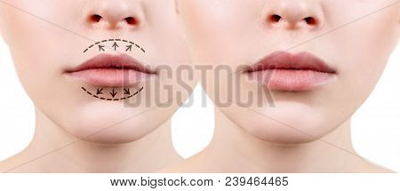 Beautiful Lips Of Young Woman. Before And After Lips Filler Injections. Fillers Concept.