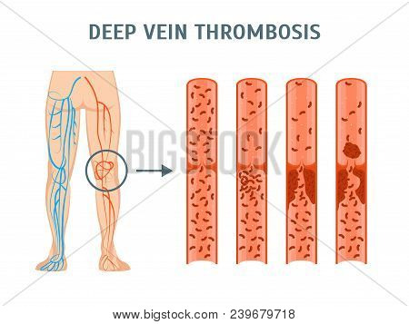 Cartoon Deep Vein Leg Thrombosis Infographics Card Poster Treatment Concept Flat Design Style. Vecto