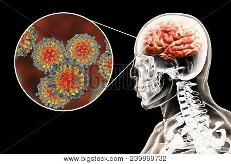 Measles-induced Encephalitis, Medical Concept, 3d Illustration Showing Brain Infection And Close-up 