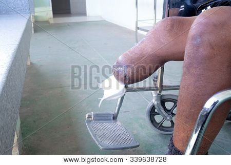Patient Sitting On Wheelchair