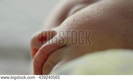Macro shot of a sleeping childs face affected by diathesis. Troubled face skin of a small caucasian baby.  Childs face with skin defect. Closeup footage of babies cheeks.