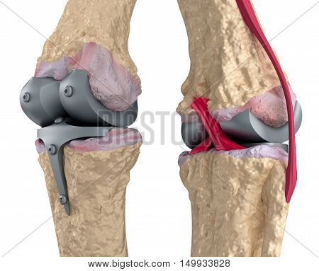 Knee and titanium hinge joint. Isolated on white