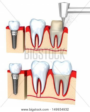 Dental crown installation process isolated on white