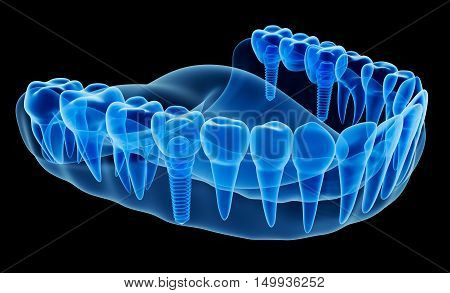 X-ray view of denture with implant,3D render