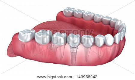 Lower teeth and dental implant transparent render isolated on white . 3D illustration