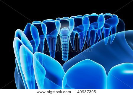 X-ray view of denture with implant, 3D render