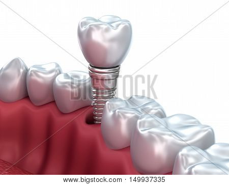 Dental implant Medically accurate 3D illustration,3D render