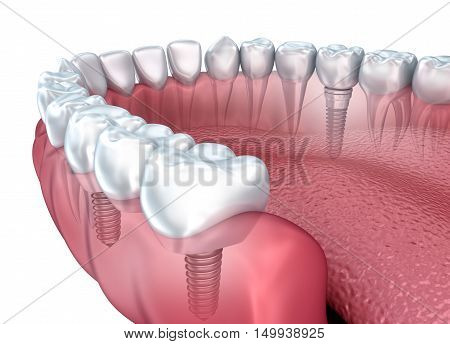 Lower teeth and dental implant transparent render isolated on white . 3D illustration