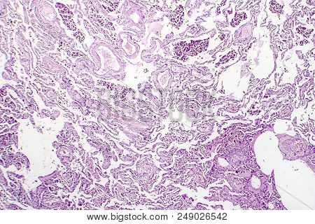 Chronic Pulmonary Congestion, Light Micrograph. Photo Under Microscope
