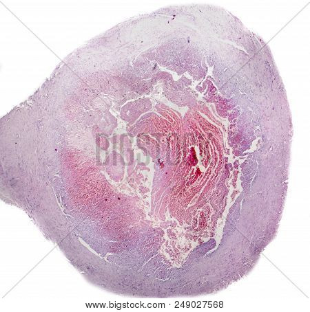 Thrombus Inside Vein, Light Micrograph, Hematoxylin And Eosin Staining