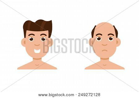 Hair Stages Loss. Types Of Baldness On Male Head Vector.