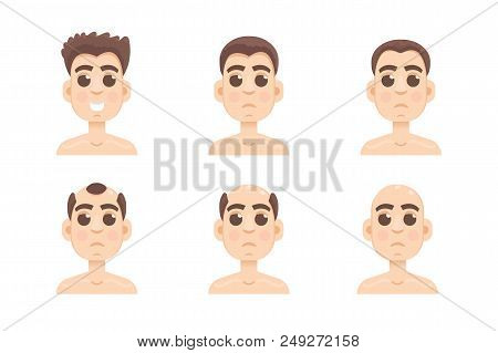 Hair Stages Loss. Types Of Baldness On Male Head Vector.