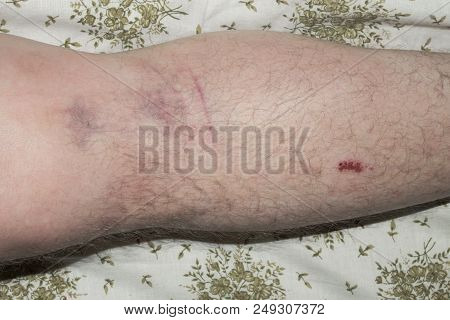 Damaged Swollen Knee Or Dislocation Of The Patella.