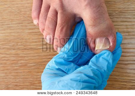 Ingrown Toenail On Foot. Doctor Examines Thumb.