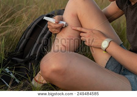 Young Woman Hiker Applies First Aid Medication Ointment On Injured Leg Outdoors. Female Person Uses 