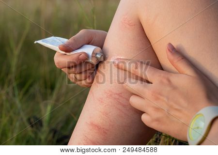 Applying First Aid Medication Ointment On Injured Leg Outdoors. Close Up Image Of Using Ointment To 