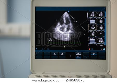 The Screen Of The Ultrasound Device Shows A Scan Of The Heart In A Four-chamber Position And The Cav