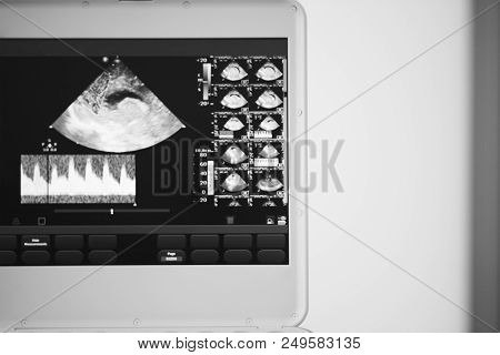 On The Screen Of An Ultrasound Machine Is An Image Of A Saggital Scan Of The Brain, Passing Through 