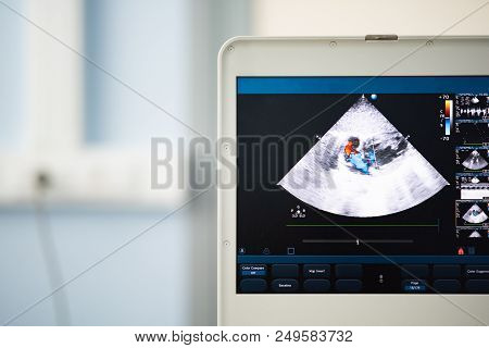 On The Screen Of A Modern Ultrasound Scanner, An Image Of The Heart Cavities With Red And Blue Strea