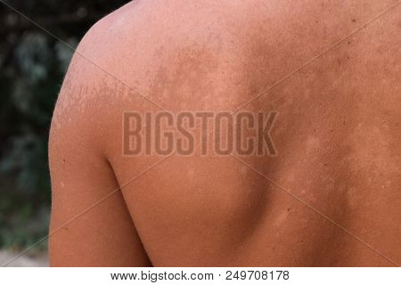 Sunburn On The Skin Of The Back. Exfoliation, Skin Peels Off. Dangerous Sun Tan