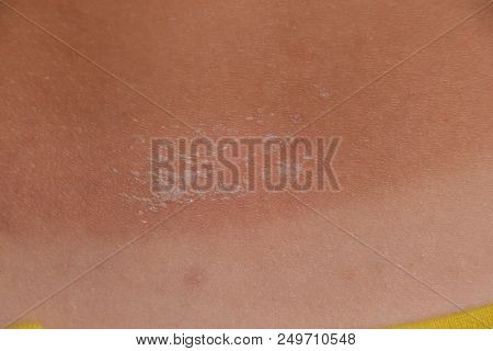 Sunburn On The Skin Of The Back. Exfoliation, Skin Peels Off. Dangerous Sun Tan