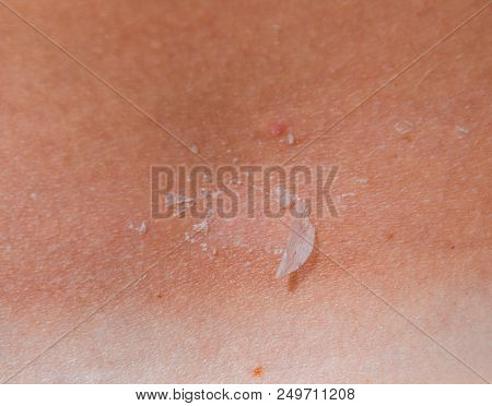 Sunburn On The Skin Of The Back. Exfoliation, Skin Peels Off. Dangerous Sun Tan