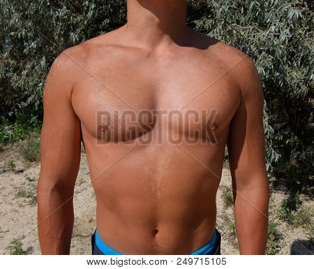 Sunburn On The Skin Of The Chest And Abdomen Of A Man. Exfoliation, Skin Peels Off. Dangerous Sun Ta