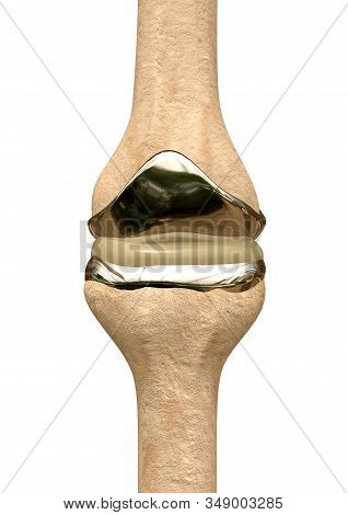 Metallic Knee Prosthesis Replacing Bone Structures Worn By Osteoporosis Or A Sports Accident. 3d Ren