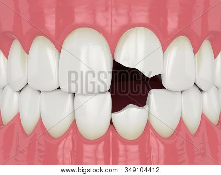 3d Render Of Jaw With Broken Two Incisors Teeth