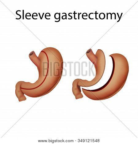 Sleeve Gastrectomy. Stomach Surgery. Before And After. Medical Anatomy Illustration.