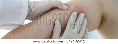 Focus On Poor Suffering Patient Skin. Hand In Glove Of Professional Doctor Looking At Painful Dermat