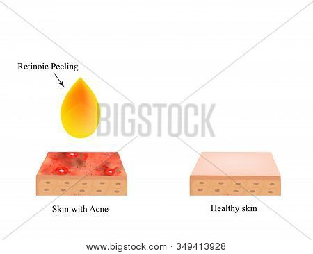Retinoic Peeling For Acne. Inflamed Skin Acne. Acne Purulent. The Anatomical Structure Of The Skin. 